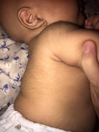 Bercak putih di kulit badan bayi
