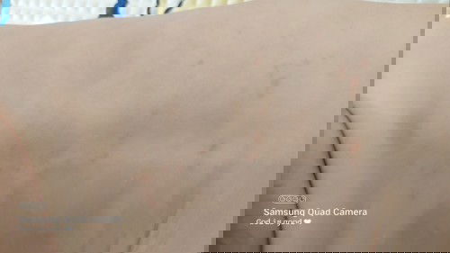 Adakah ini simptom eczhema ibu2? Ada pengalaman yang sama tak?