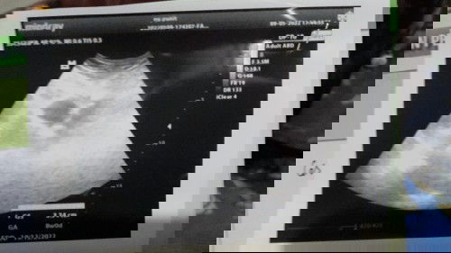 Hamil anak ke 2 di vonis BO