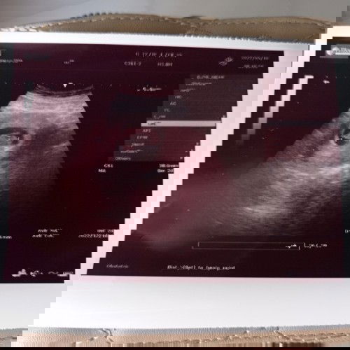 Hasil usia kehamilan sesuai usg