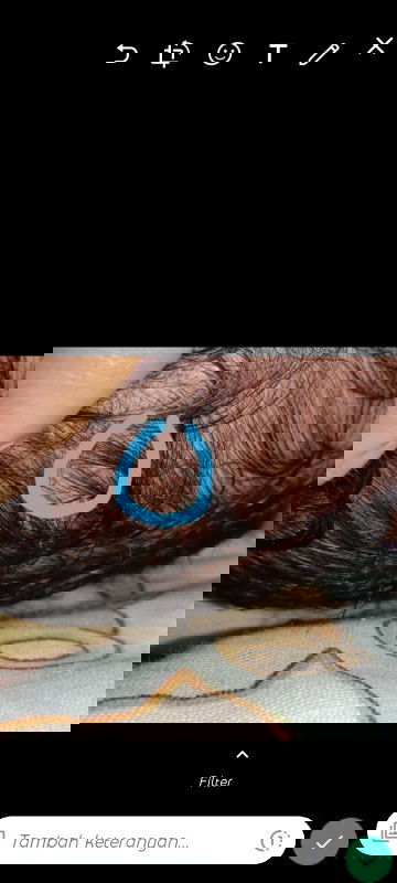 Bintik nanah dikepala