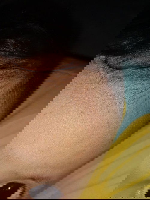 Ini cacar atau biang keringet?