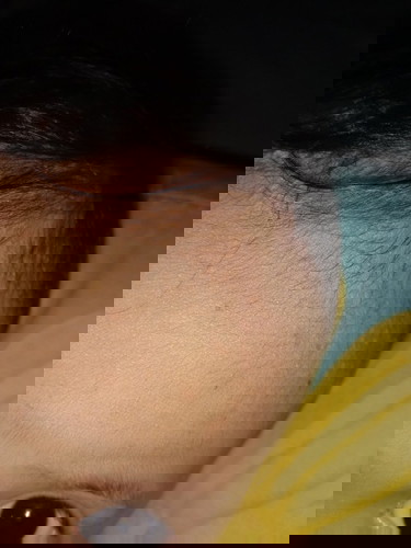 Ini cacar atau biang keringet?