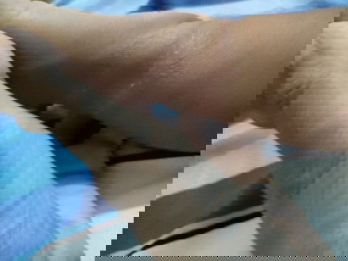 Kaki anak bersisik seperti luka