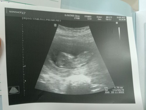 ท้องสอง ซาวด์รอบแรก
หนู 11w ท้องสองก็ยังตื่นเต้นเหมือนท้องแรกคะ แม่ๆท้องกี่วีคกันบ้างคะ 🤰❤️☺️