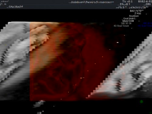 USG jenis kelamin 4D 16 minggu