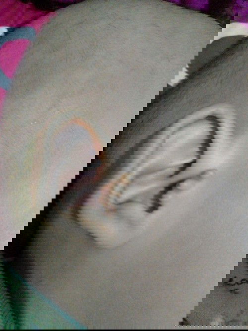 Tanda lahir (Mata Kepiting)