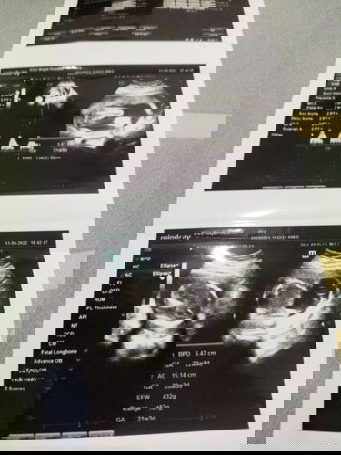 janin normal usia 21 minggu