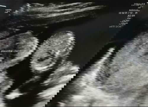bentuk placenta uk 15w