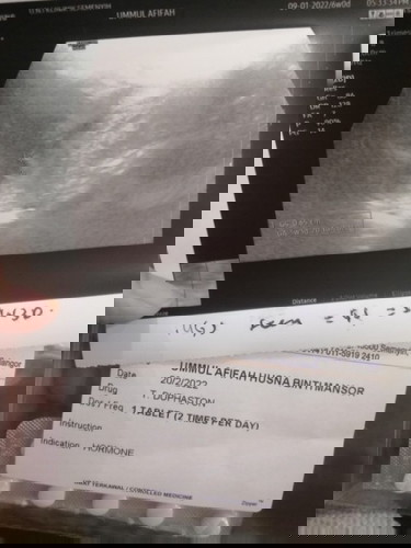 Threatened miscarriage @ keguguran