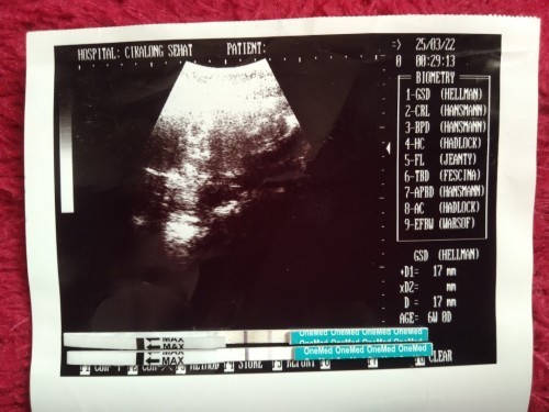 Hamil dengan KB IUD terpasang, bagi pengalaman dong bunn, soalnya kepikiran terus hehehe