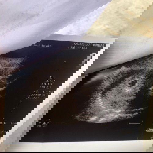 ตั้งครรภ์7week ค่ะ ท้อง2