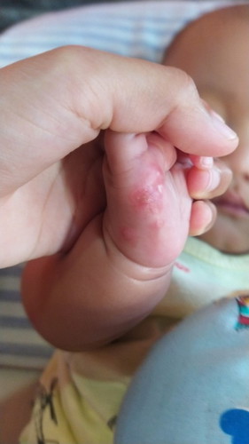 Bentol2  kyak berair