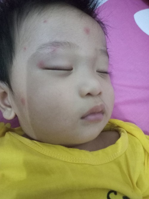 Alergi kulit / bentol merah pada bayi