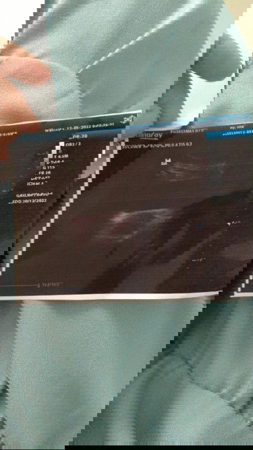 Hasil usg penebalan rahim