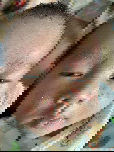 เป็นผื่นเด็ก ตอนนี้เหงื่อออกที่หัวตลอด ที่นอนเหลือง