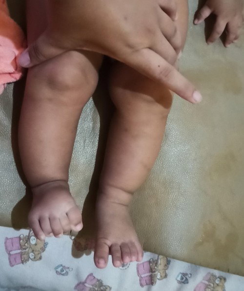 seputar kaki O dan X