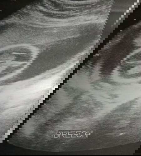 Gender ultrasound