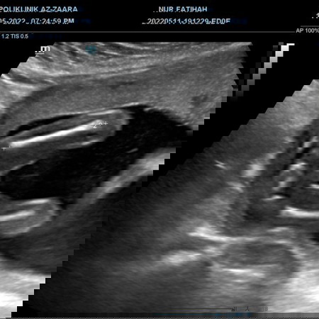 Scan gender boy or gir