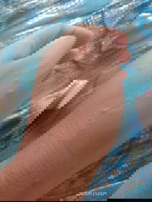 alergi atau biang keringat