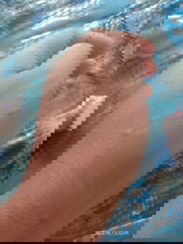 alergi atau biang keringat