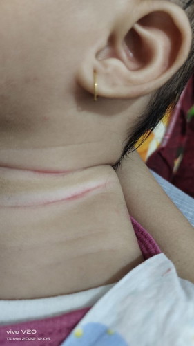 Seperti luka sayatan