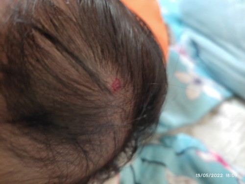 Benjol yang mempunyai darah