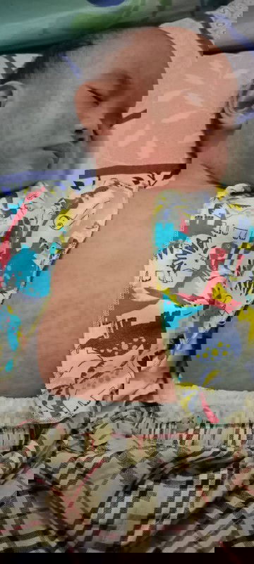 Merah-merah di kulit karena virus