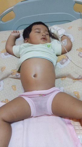 Perut anak kembung dan keras