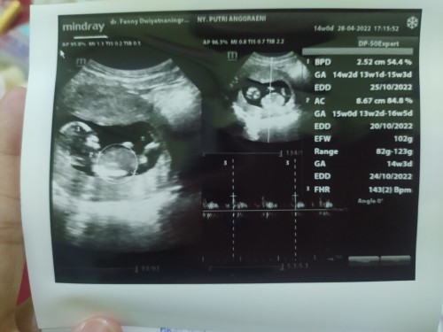 Hasil usg kehamilan 3bulan