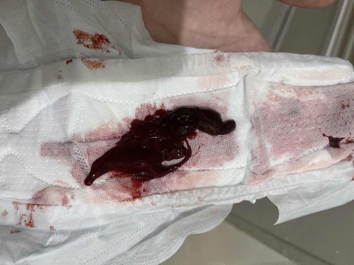 ตกเลือดหลังคลอด ได้6วัน