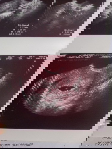 6weeks pregnant sac palang nakita.
UPDATE! MAY BABY NAPO AND HEARTBEAT 10WEEKS PREGGY HERE