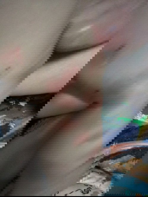 ไม่แน่ใจว่าผื่นหรือโดนอะไรกัด