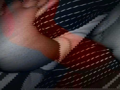 Habis demam muncul bruntusan