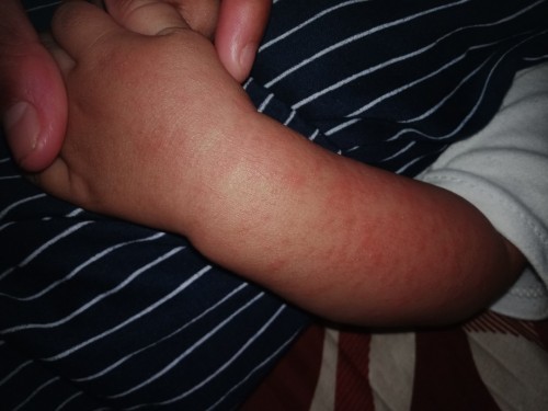 Habis demam muncul bruntusan