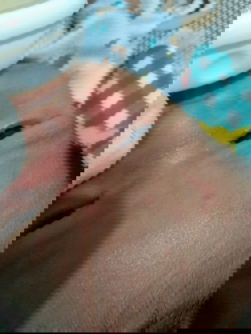 Bruntusan & hidung merah