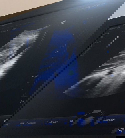 26+3 👶🏻 รูปอัลตราซาวด์ 
ขอดูของแม่ๆหน่อยค่ะ 🥰🥰🥰