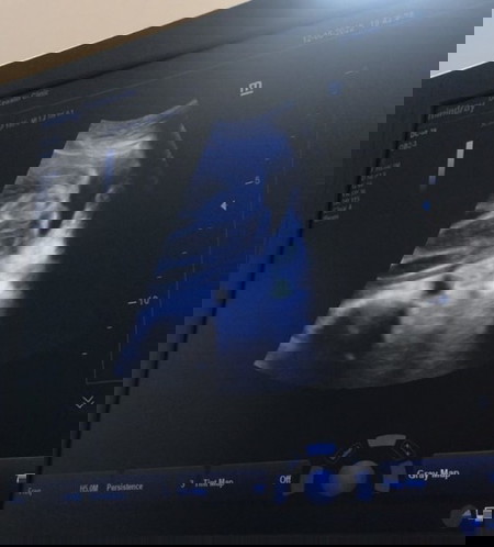 26+3 👶🏻 รูปอัลตราซาวด์ 
ขอดูของแม่ๆหน่อยค่ะ 🥰🥰🥰