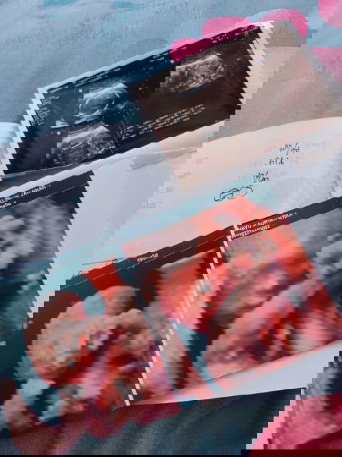 20 Weeks calon bayi perempuan