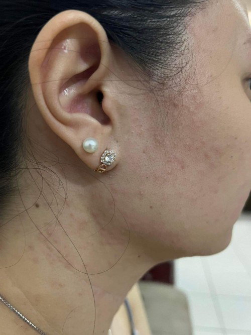 Hi, is it normal po sa 1st trimester magkaron ng ganitong rashes? Sa chest neck and face tyia.