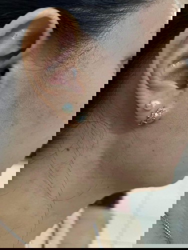 Hi, is it normal po sa 1st trimester magkaron ng ganitong rashes? Sa chest neck and face tyia.