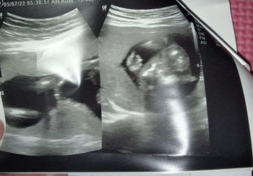 17weeks po ako nagpaultradound kasi gusto ko makita ang gender ni bb. kaso inverted position siya.
