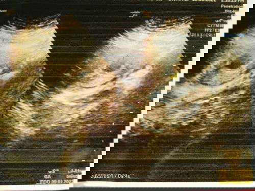 Usia kehamilan sudh 7minggu 
Pas di USG kantong Masi kosong