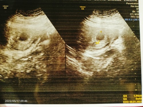 Usia kehamilan sudh 7minggu
Pas di USG kantong Masi kosong