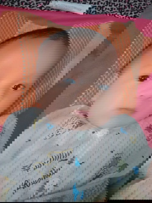 Bé bị cứt trâu