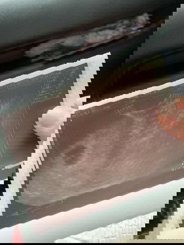 Gestational sac and yolk sac