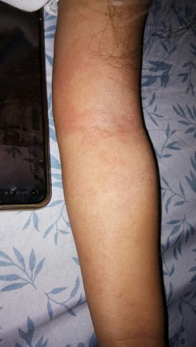 RASHES Sa arm, sa tigiliran at binte
