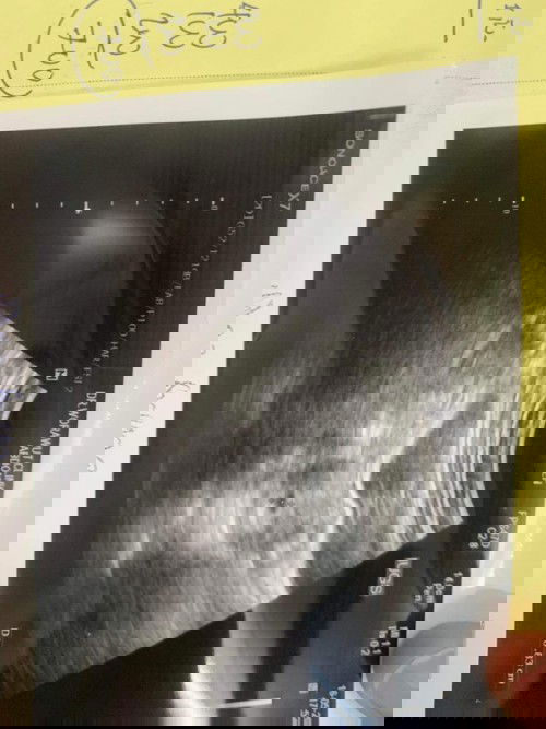 ถุงตั้งครรภ์ 4 สัปดาห์