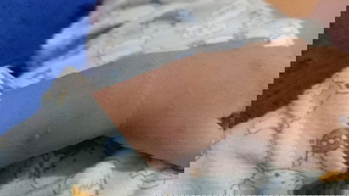 Bun. Ada Rekomendasi krim cacar air ga bun.  Biar gak berbekas dan biar gak gatel.