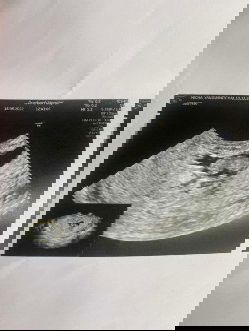 หัวใจเด็กไม่เต้น 8 วีท